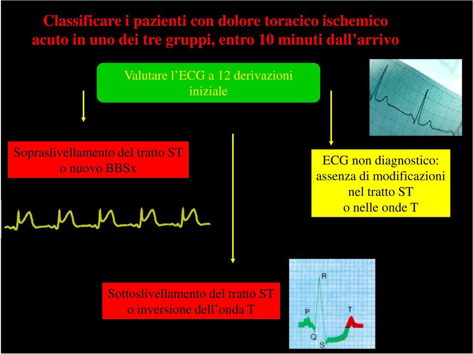 Sopraslivellamento del tratto ST o nuovo BBSx ECG non diagnostico: assenza di