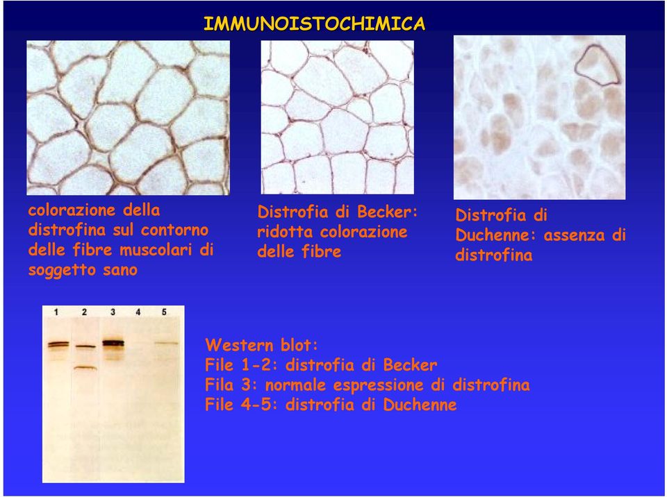 fibre Distrofia di Duchenne: assenza di distrofina Western blot: File 1-2: