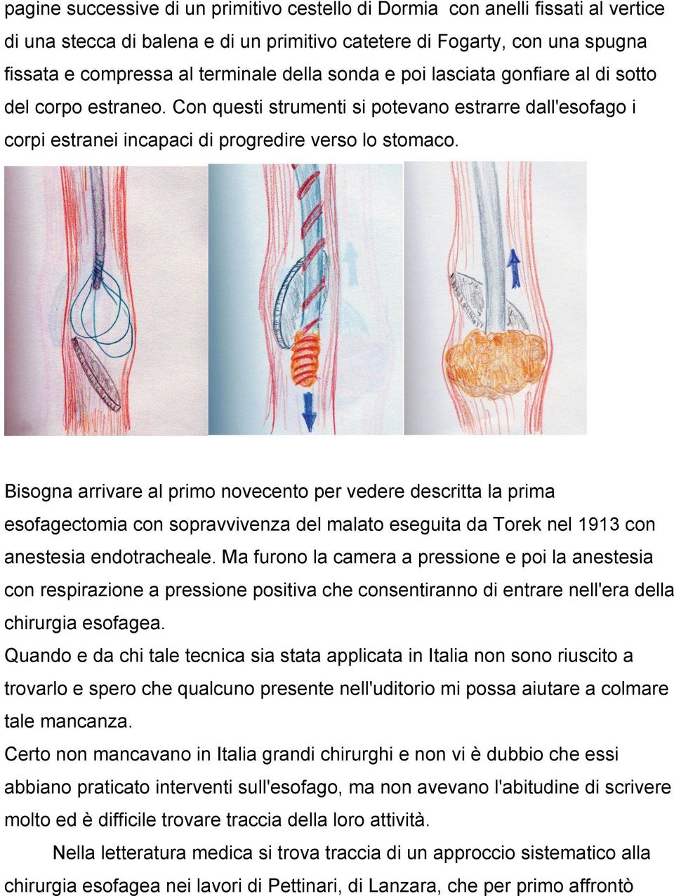 Bisogna arrivare al primo novecento per vedere descritta la prima esofagectomia con sopravvivenza del malato eseguita da Torek nel 1913 con anestesia endotracheale.