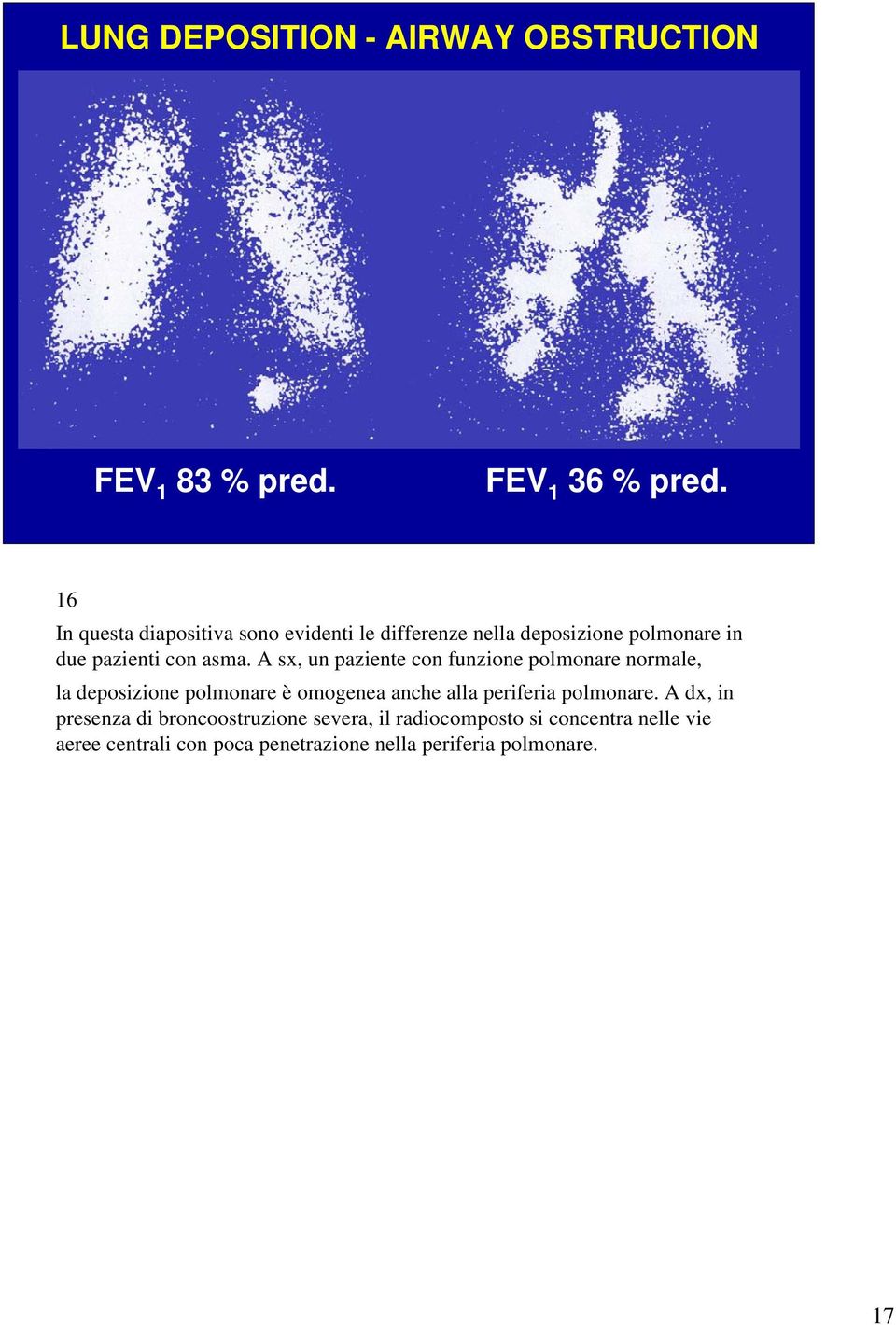 A sx, un paziente con funzione polmonare normale, la deposizione polmonare è omogenea anche alla periferia