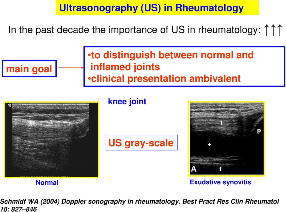 presentation ambivalent knee joint US gray-scale Normal Exudative synovitis Schmidt