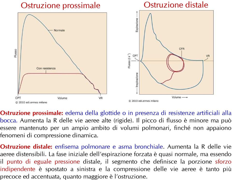 Ostruzione distale: enfisema polmonare e asma bronchiale. Aumenta la R delle vie aeree distensibili.