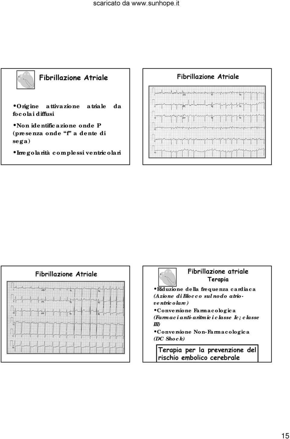 Riduzione della frequenza cardiaca (Azione di Blocco sul nodo atrioventricolare) Conversione Farmacologica (Farmaci