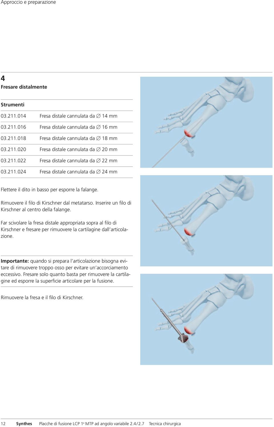Inserire un filo di Kirschner al centro della falange. Far scivolare la fresa distale appropriata sopra al filo di Kirschner e fresare per rimuovere la cartilagine dall articolazione.