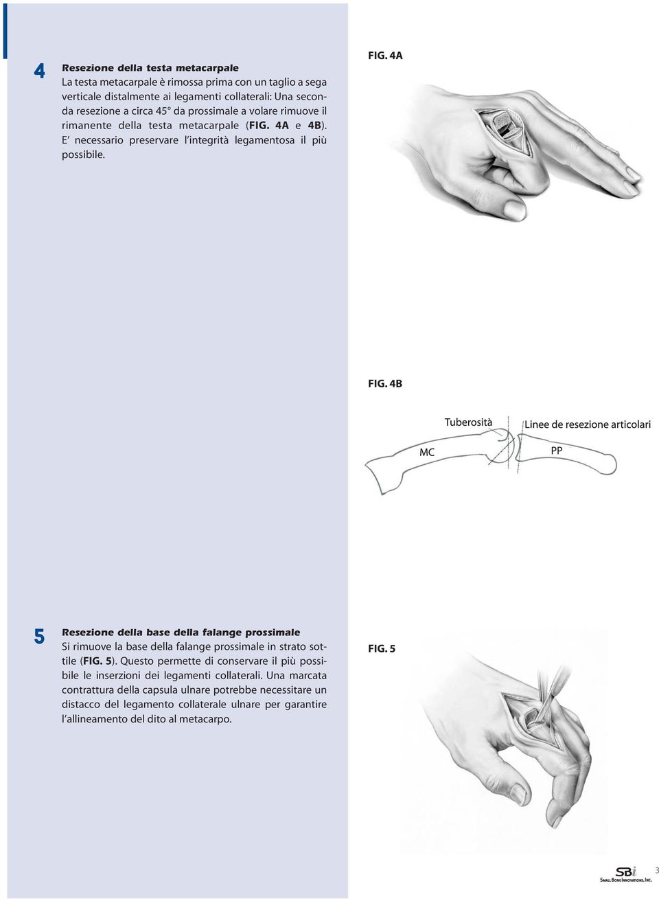 4B 5 Resezione della base della falange prossimale Si rimuove la base della falange prossimale in strato sottile (FIG. 5).