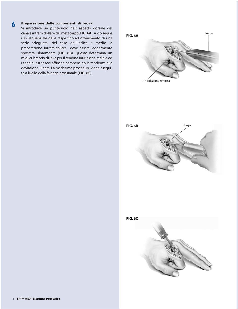 Nel caso dell indice e medio la preparazione intramidollare deve essere leggermente spostata ulnarmente (FIG. 6B).