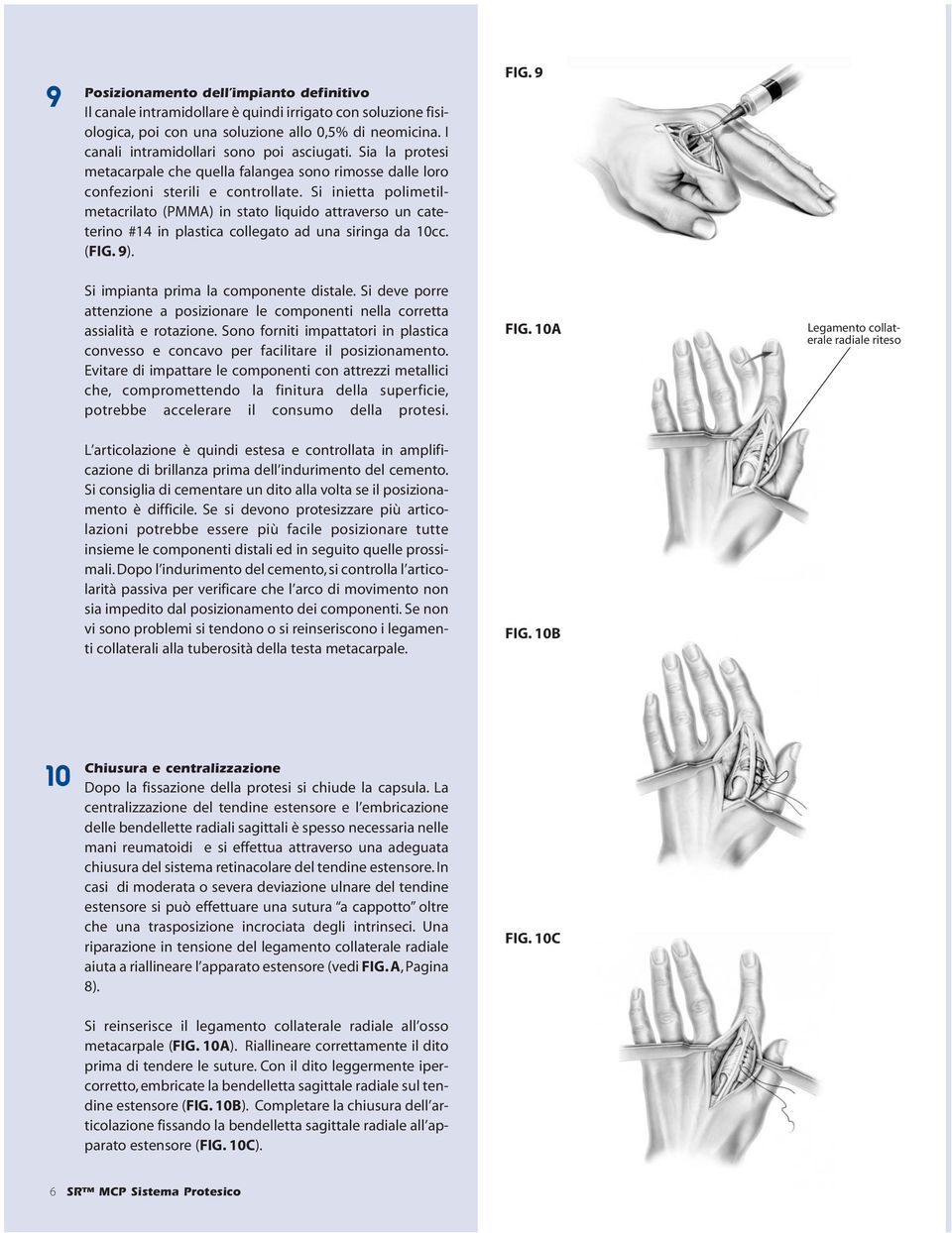 Si inietta polimetilmetacrilato (PMMA) in stato liquido attraverso un cateterino #14 in plastica collegato ad una siringa da 10cc. (FIG. 9). FIG. 9 Si impianta prima la componente distale.