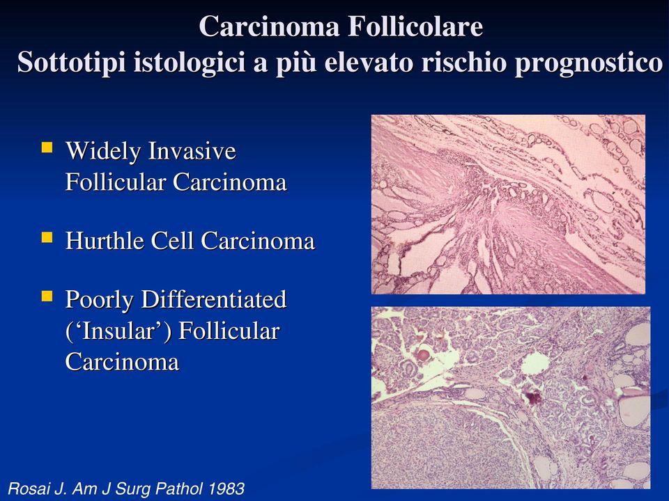 Carcinoma Hurthle Cell Carcinoma Poorly Differentiated