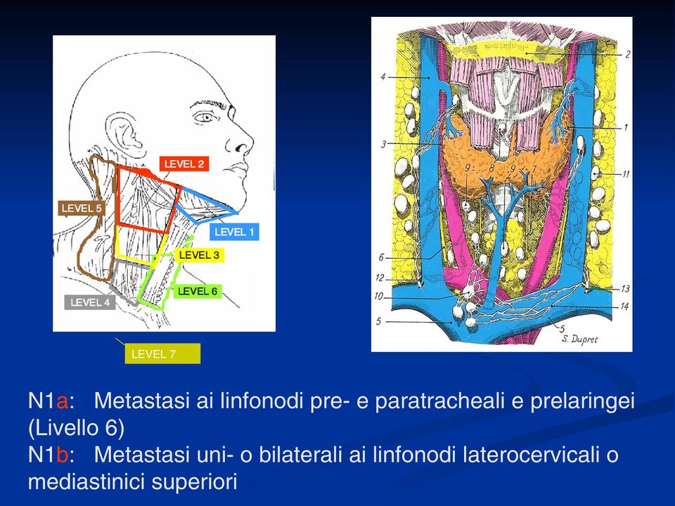 N1b: Metastasi uni- o bilaterali ai