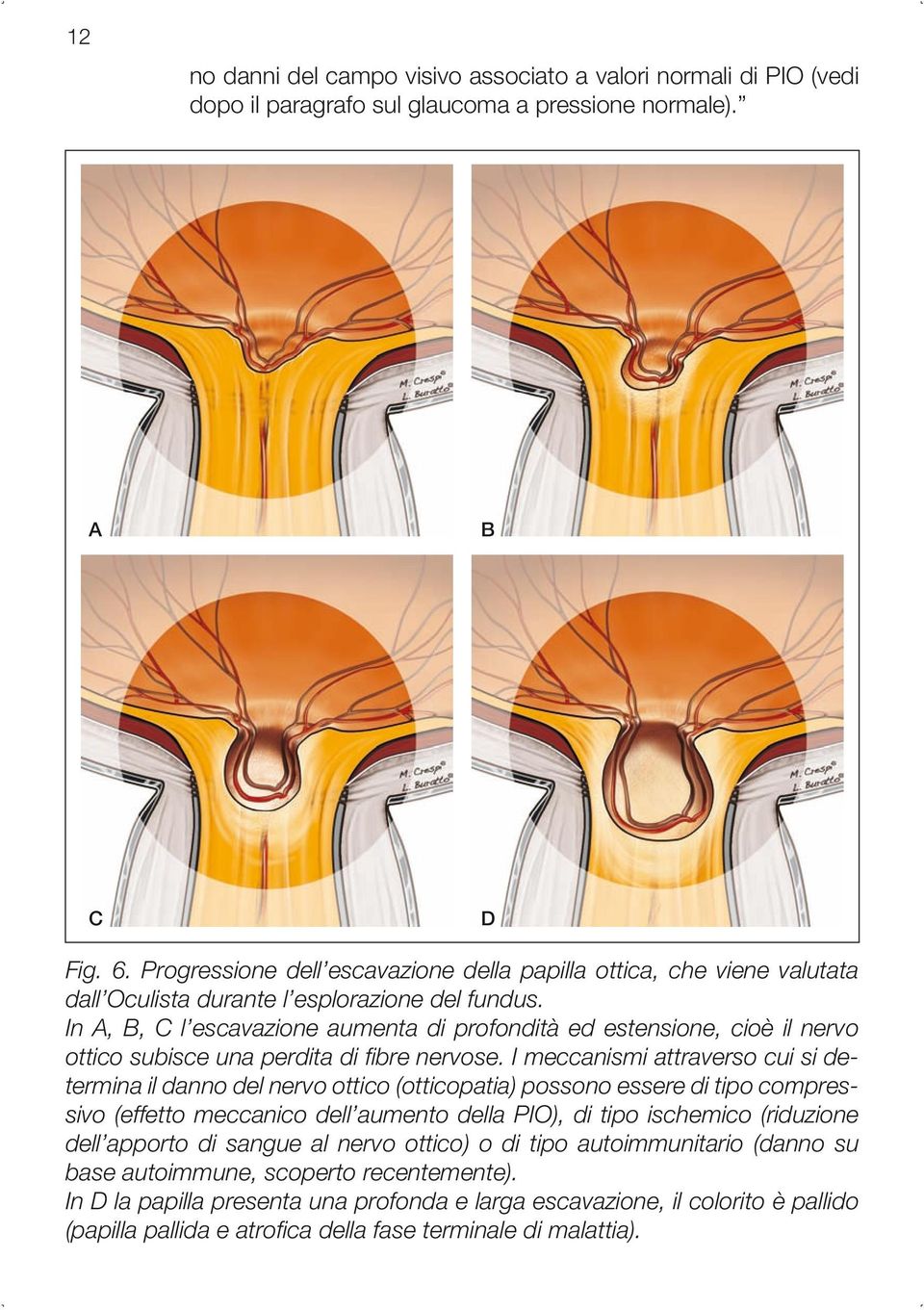 In A, B, C l escavazione aumenta di profondità ed estensione, cioè il nervo ottico subisce una perdita di fibre nervose.