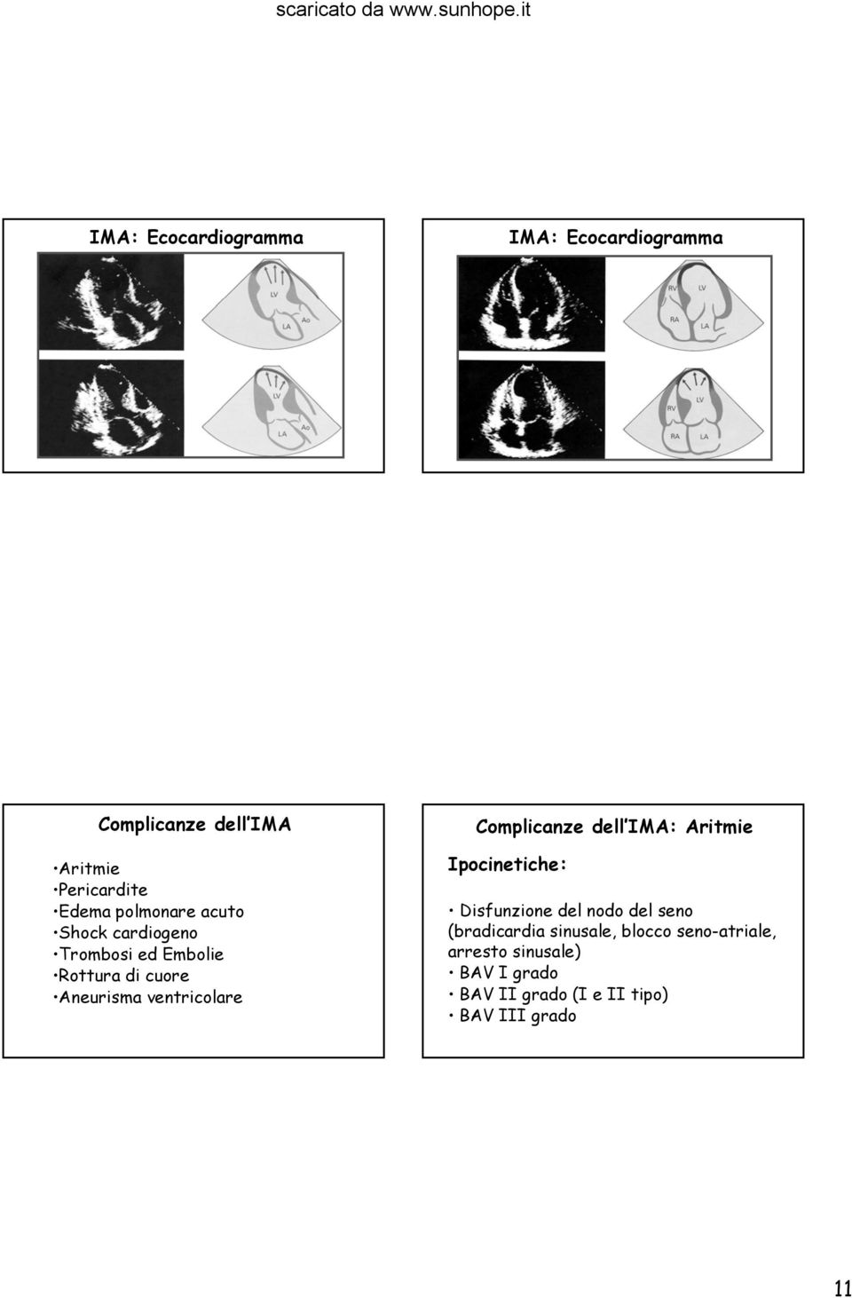 Complicanze dell IMA: Aritmie Ipocinetiche: Disfunzione del nodo del seno (bradicardia