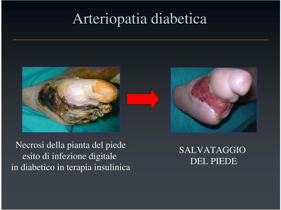 infezione digitale in diabetico in