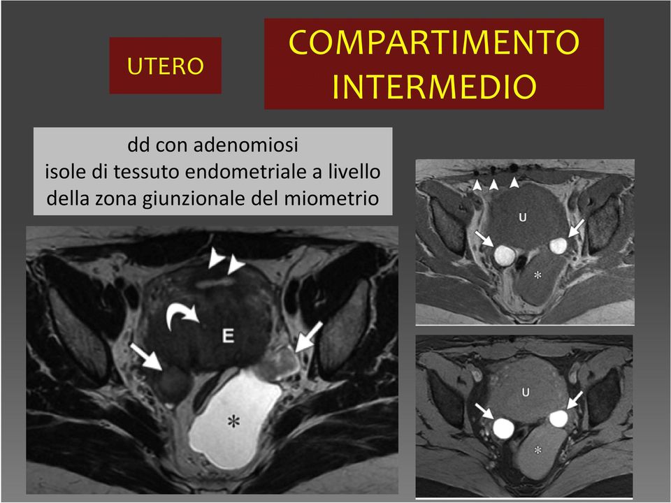 tessuto endometriale a livello