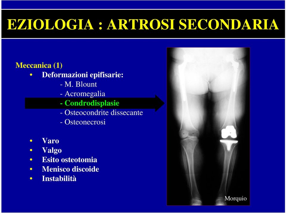 Blount - Acromegalia - Condrodisplasie - Osteocondrite