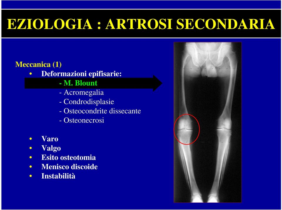 Blount - Acromegalia - Condrodisplasie -