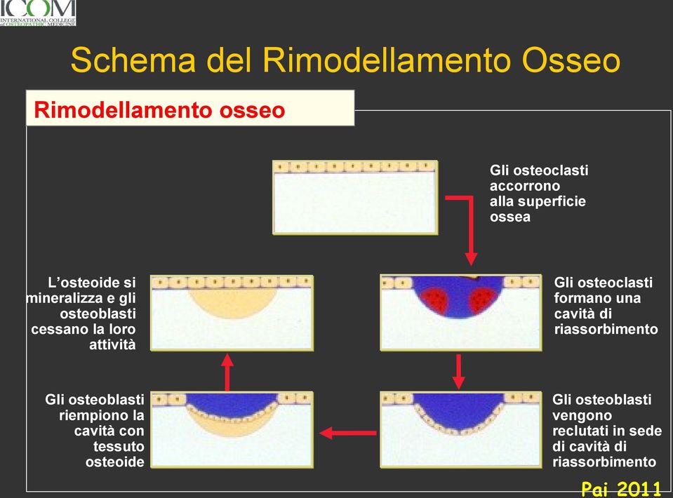 Gli osteoblasti riempiono la cavità con tessuto osteoide Gli osteoclasti formano una