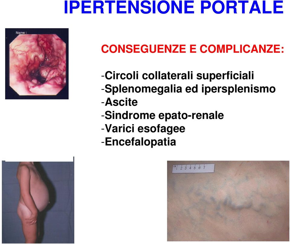 superficiali -Splenomegalia ed