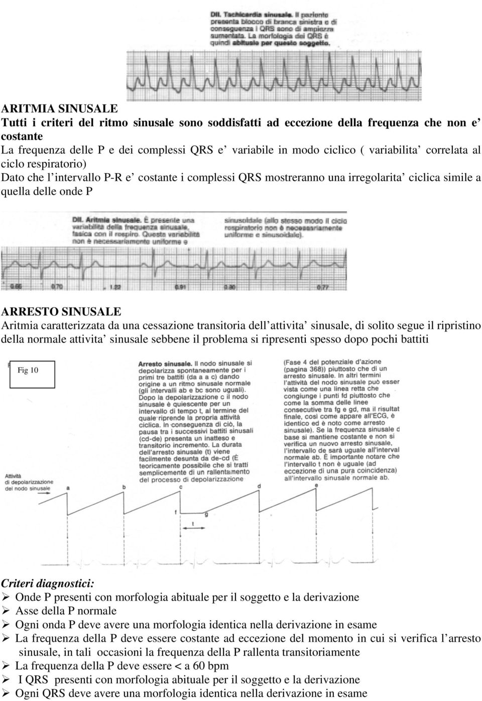 cessazione transitoria dell attivita sinusale, di solito segue il ripristino della normale attivita sinusale sebbene il problema si ripresenti spesso dopo pochi battiti Fig 10 Criteri diagnostici: