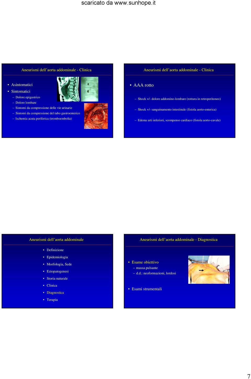 addomino-lombare (rottura in retroperitoneo) Shock +/- sanguinamento intestinale (fistola aorto-enterica) Edema arti