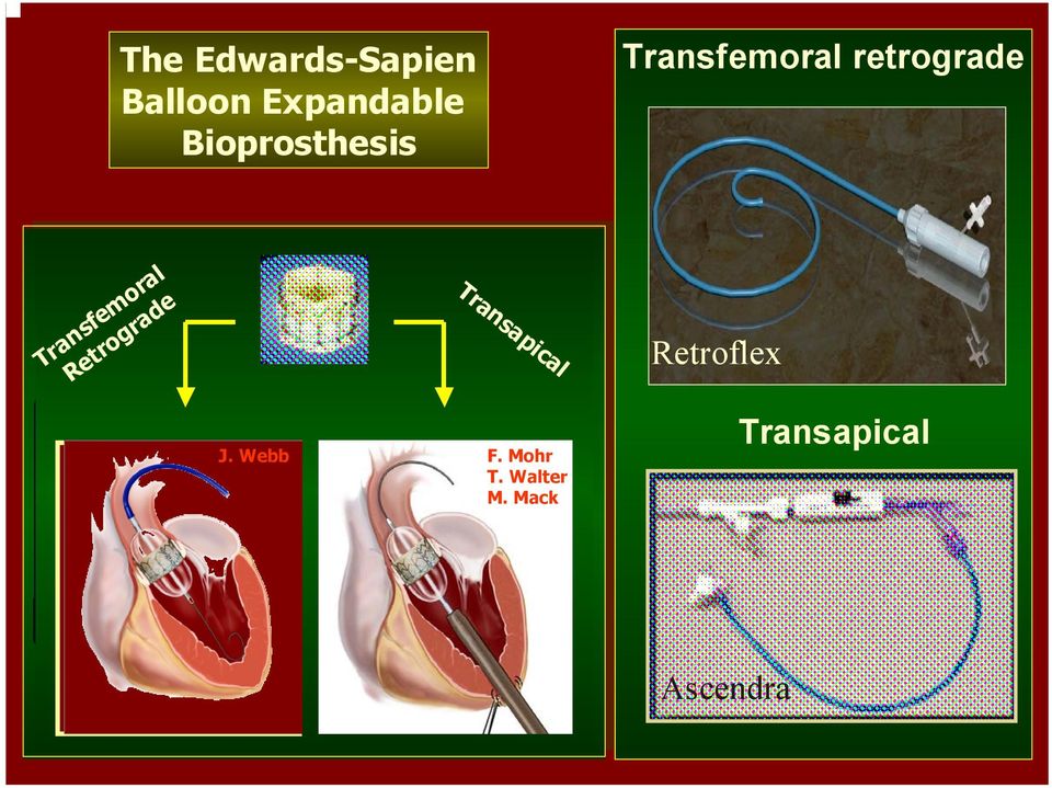 Transapical Retroflex J. Webb F. Mohr T. Walter M.