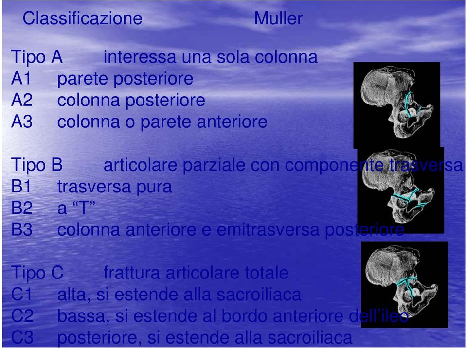 B3 colonna anteriore e emitrasversa posteriore Tipo C frattura articolare totale C1 alta, si estende