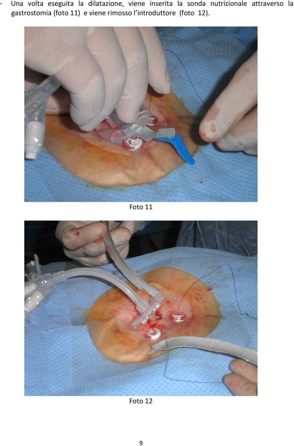la gastrostomia (foto 11) e viene rimosso