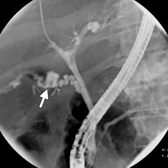 RICONOSCIMENTO POSTOPERATORIO PRECOCE