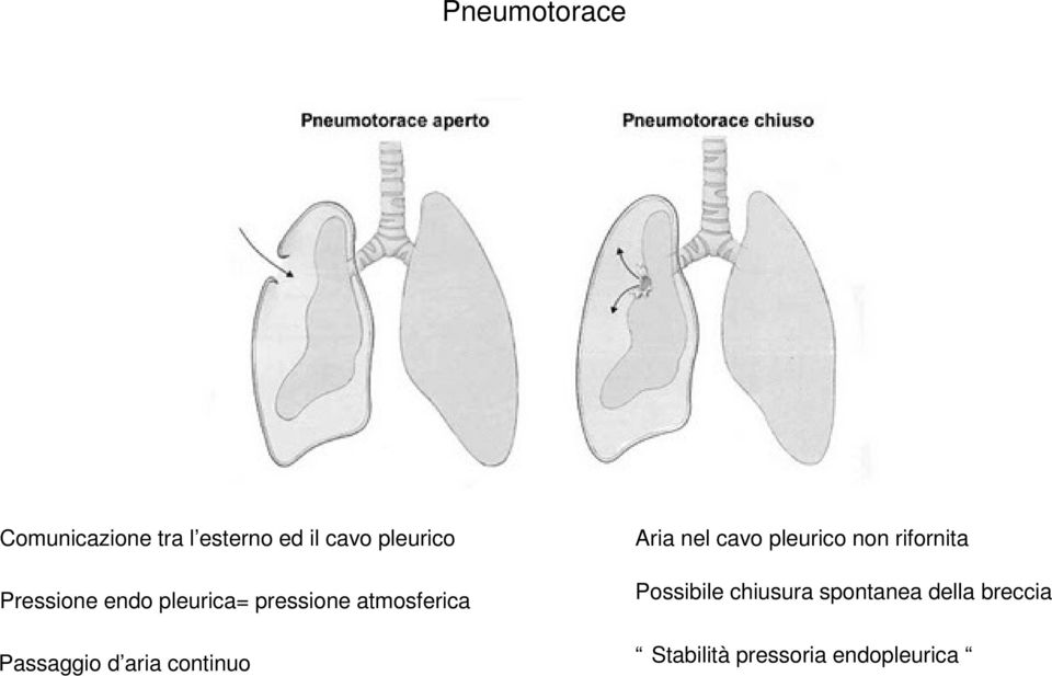 continuo Aria nel cavo pleurico non rifornita Possibile