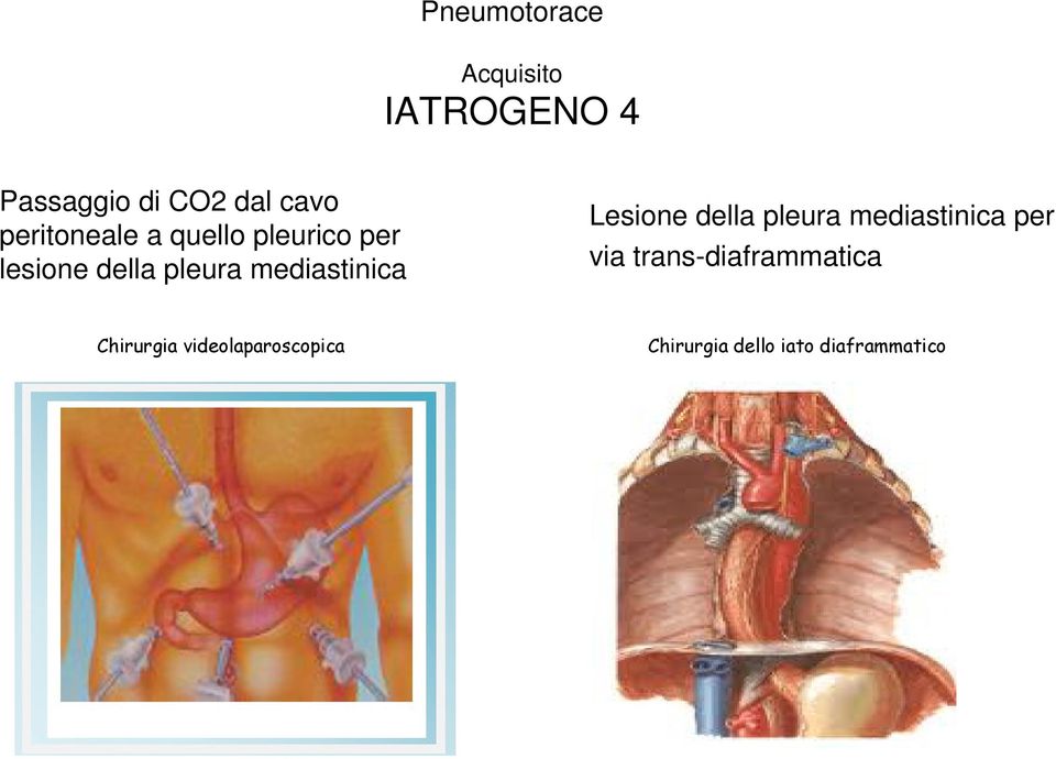 Lesione della pleura mediastinica per via