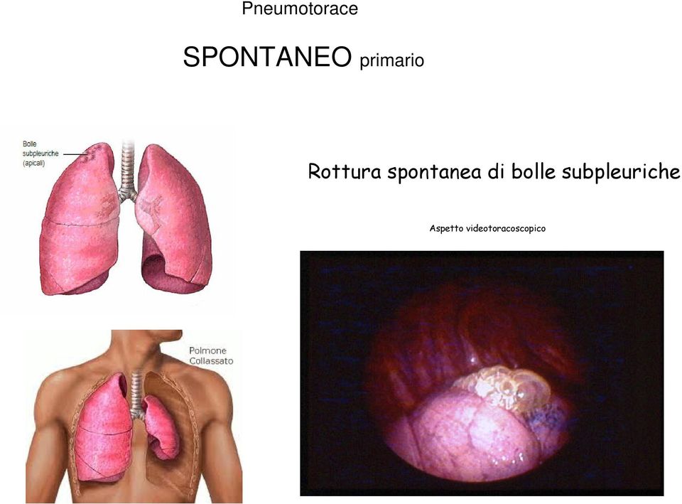 bolle subpleuriche