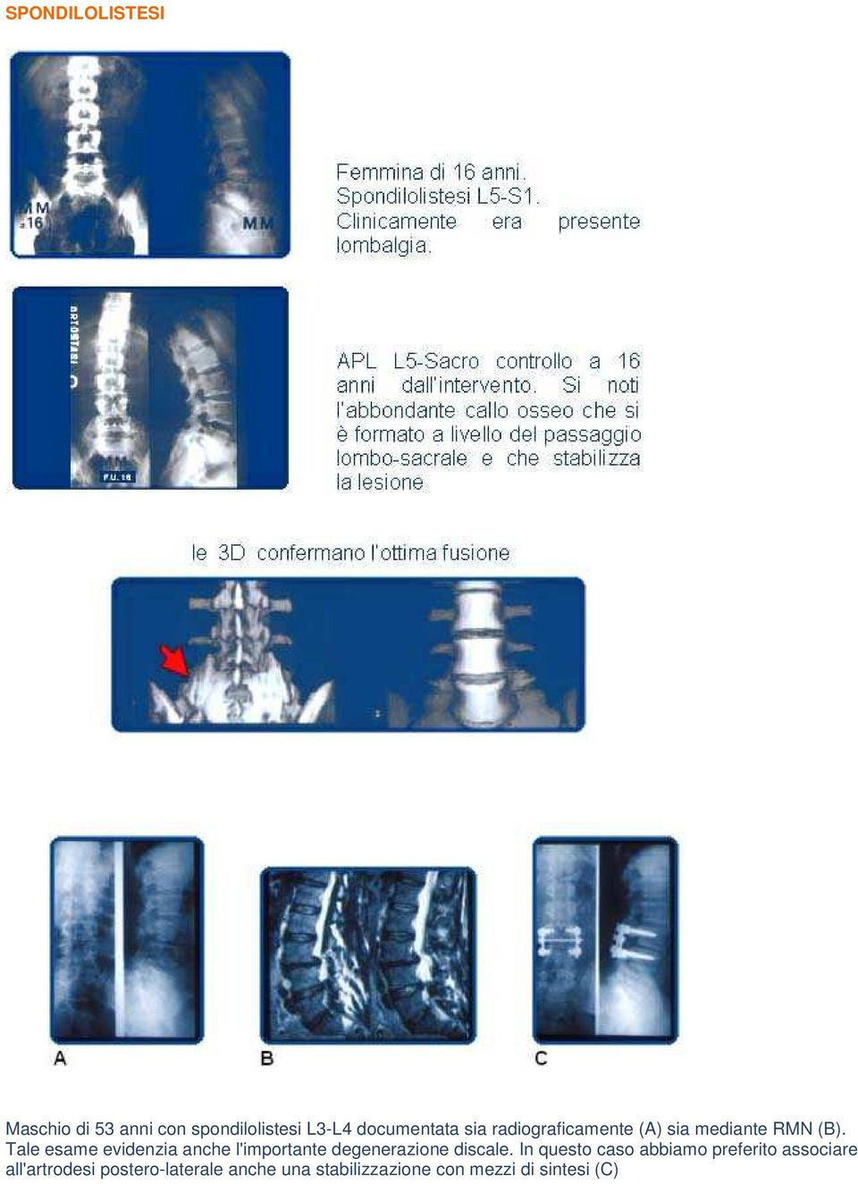 Tale esame evidenzia anche l'importante degenerazione discale.