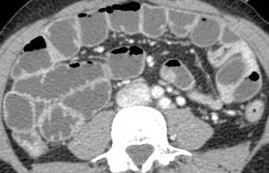 Donna 29 aa: crisi sub occlusive, anemizzazione Ispessimento parete: multipli nodulari endoluminali Impregnazione :