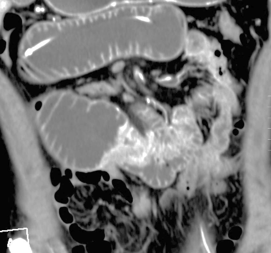 Uomo 44aa, vomito, anemizzazione e dimagrimento Ispessimento