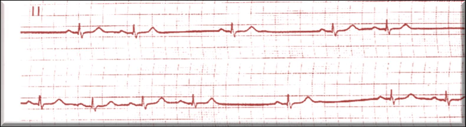 Secondo grado Tipo 2 o Mobitz 1. Ritmo sinusale normale che improvvisamente si interrompe con una pausa 2. La pausa è uguale al doppio del ciclo sinusale 3.