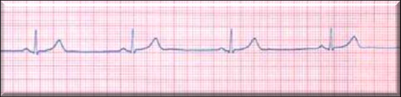 1. Presenti Onde P sempre 2. Frequenza < 60 m 3. Morfologia normale per derivazione (+ in D I-II-aVF, - avr) 4. Asse di P: 0 e +90 5.