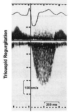 Relazione tra gradiente tricuspidale al Doppler e pressione polmonare media