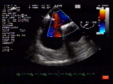 Eco nella diagnosi di ipertensione polmonare III