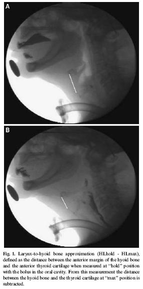 Larynx-to-hyoid bone approximation (HL hold HL max) Terk et al.