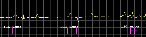 Valori elettrocardiografici