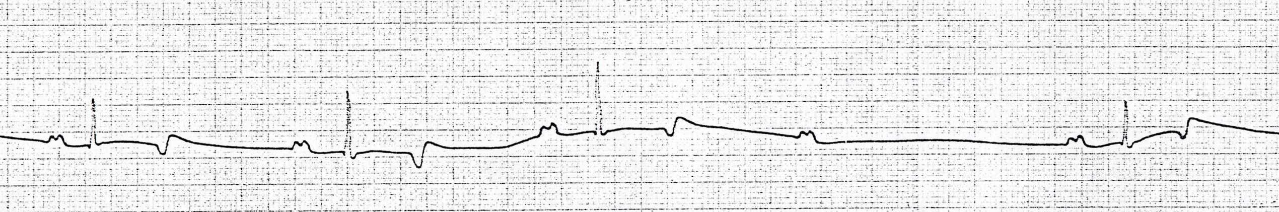 Disturbi di conduzione dello stimolo Blocchi Atrio-Ventricolari (AV) DIII P QRS T Cv Blocco AV di I grado: intervallo P-Q = 560