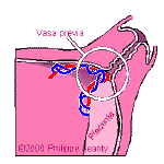 PATOLOGIA DEL III TRIMESTRE VASI PREVI Incidenza : 3 : 10000