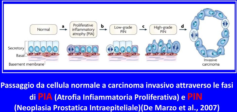 Infiammatoria Proliferativa) e PIN (Neoplasia