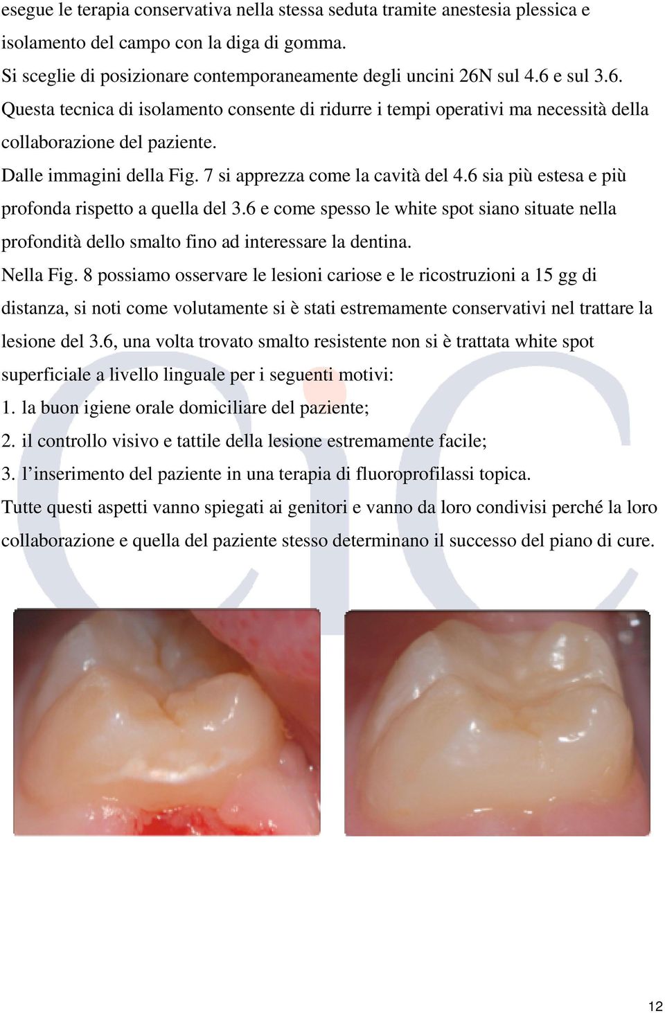 6 sia più estesa e più profonda rispetto a quella del 3.6 e come spesso le white spot siano situate nella profondità dello smalto fino ad interessare la dentina. Nella Fig.