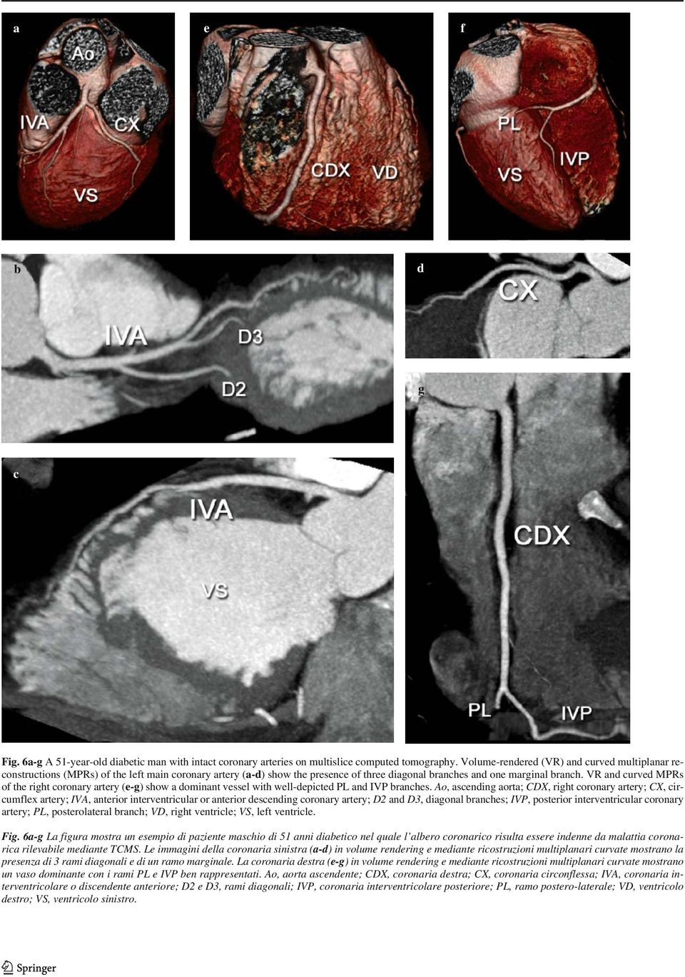 VR and curved MPRs of the right coronary artery (e-g) show a dominant vessel with well-depicted PL and IVP branches.