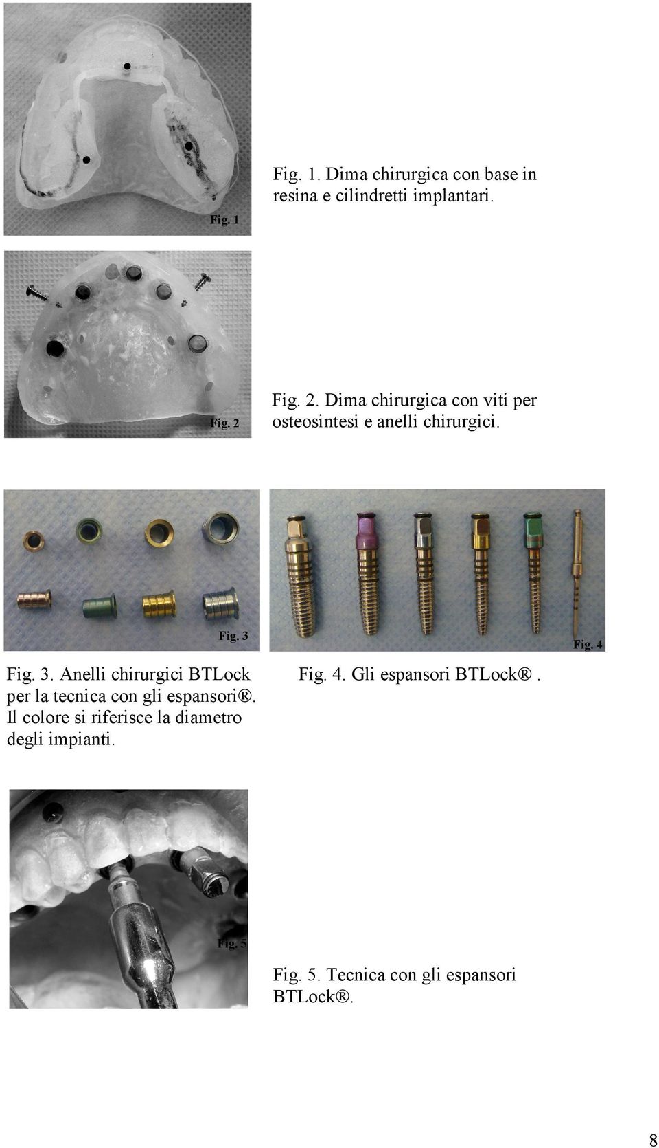 Fig. 3. Anelli chirurgici BTLock per la tecnica con gli espansori.