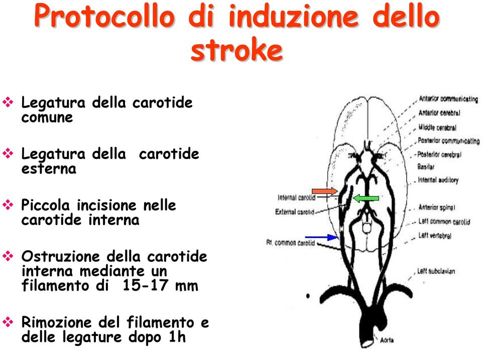 carotide interna Ostruzione della carotide interna mediante un