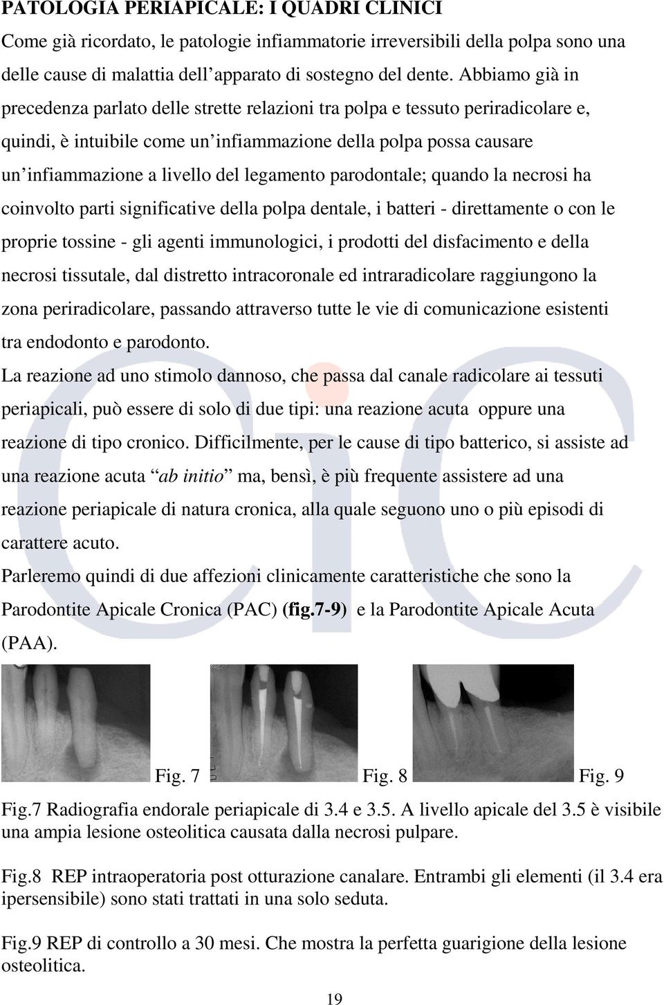 legamento parodontale; quando la necrosi ha coinvolto parti significative della polpa dentale, i batteri - direttamente o con le proprie tossine - gli agenti immunologici, i prodotti del disfacimento