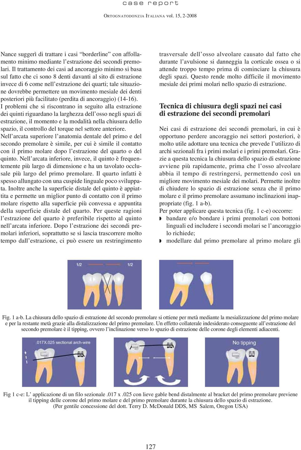 movimento mesiale dei denti posteriori più facilitato (perdita di ancoraggio) (14-16).
