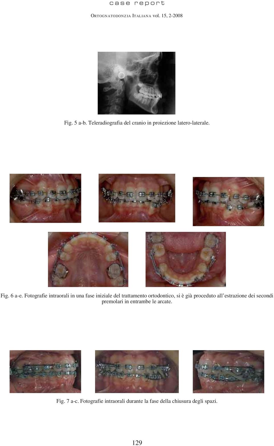 Fotografie intraorali in una fase iniziale del trattamento ortodontico, si è