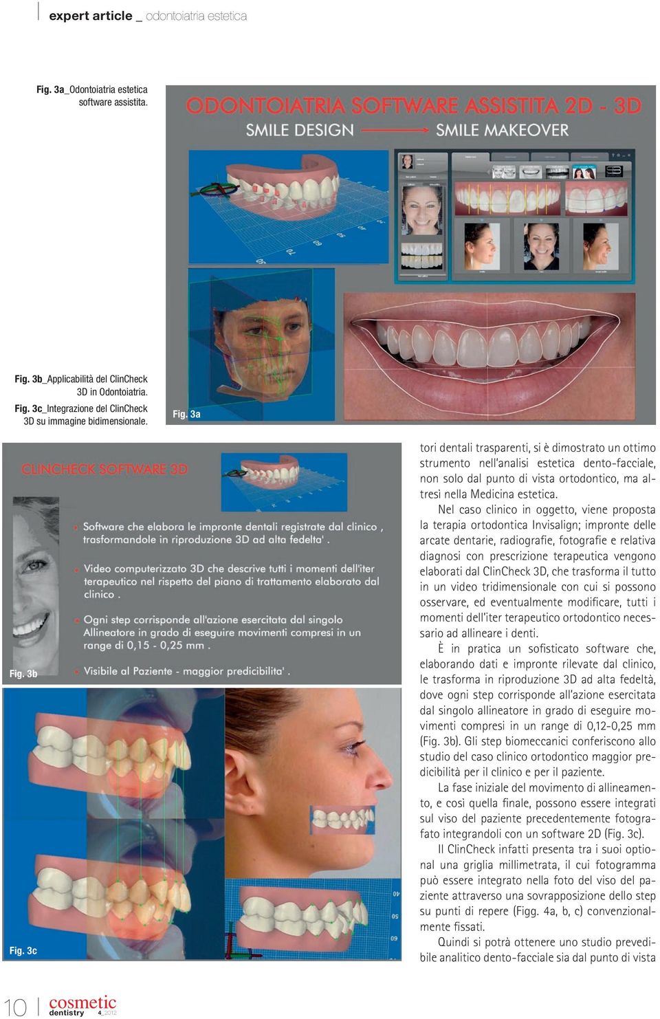 Nel caso clinico in oggetto, viene proposta la terapia ortodontica Invisalign; impronte delle arcate dentarie, radiografie, fotografie e relativa diagnosi con prescrizione terapeutica vengono